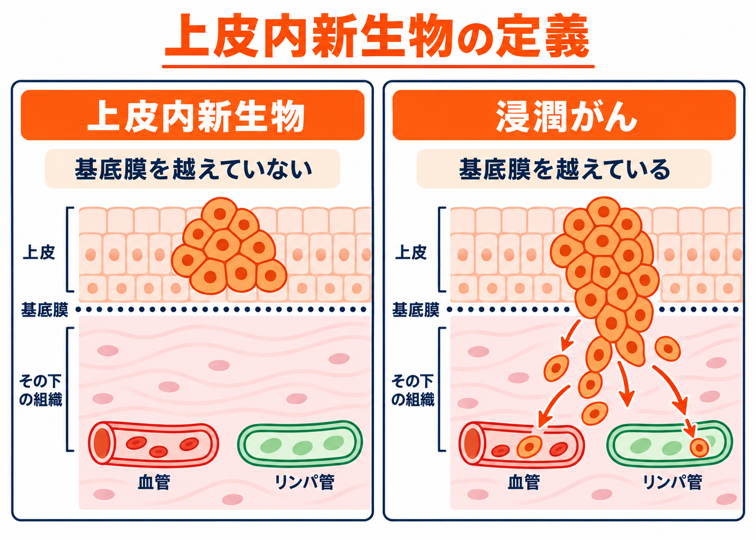 上皮内新生物（上皮内がん）とは？悪性新生物との違いやがん保険での扱いを解説