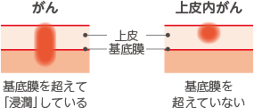 上皮内がんとは がん細胞が上皮内にとどまっており、それ以上は浸潤していない初期のがんのことをいいます。