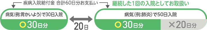 病気(例：胃かいよう)で30日入院 30日分お支払い 20日後 継続した1回の入院としてお取扱い 病気(例：肺炎)で50日入院 30日分お支払い 20日分は支払われない 疾病入院給付金 合計60日分お支払い