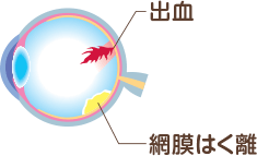 出血、網膜はく離