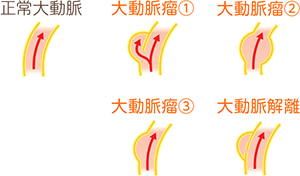 正常大動脈、大動脈瘤〈りゅう〉1、大動脈瘤〈りゅう〉2、大動脈瘤〈りゅう〉3、大動脈解離