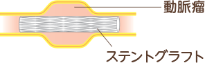 動脈瘤、ステントグラフト