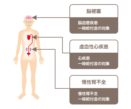 脳梗塞：脳血管疾患、一時給付金の対象。虚血性心疾患：心疾患、一時給付金の対象。慢性腎不全：慢性腎不全、一時給付金の対象。